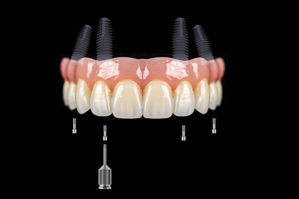 Can All-on-4 Replace Multiple Teeth?