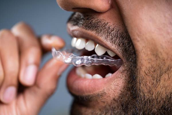 Clear Aligners Tucson, AZ