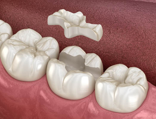 Dental Fillings Tucson, AZ