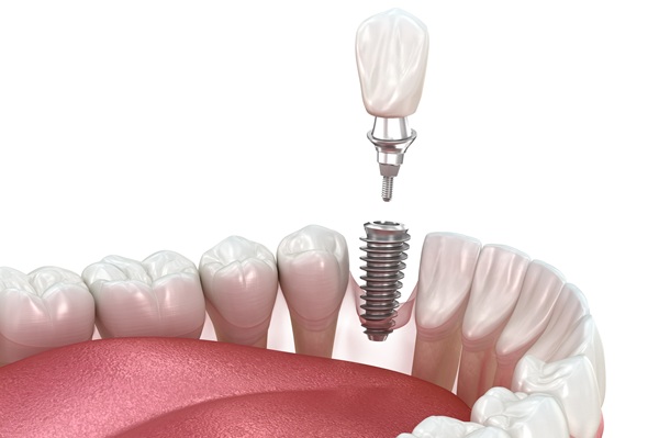 Am I a Candidate for Implant Restoration?