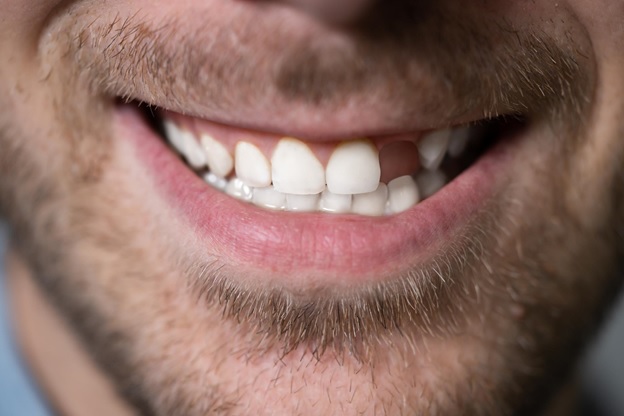 Dental Implants Tucson, AZ