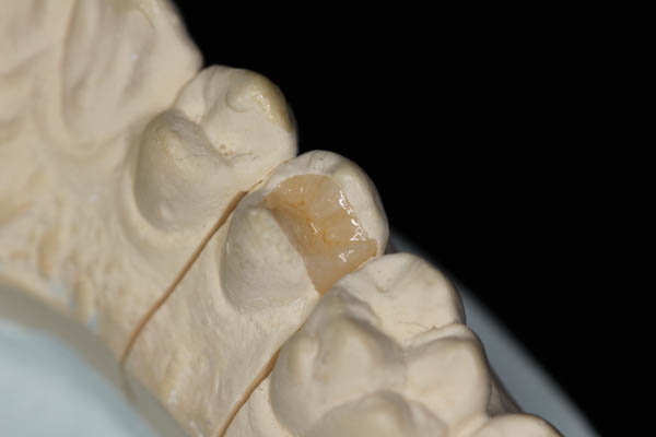 Dental Inlay Tucson, AZ