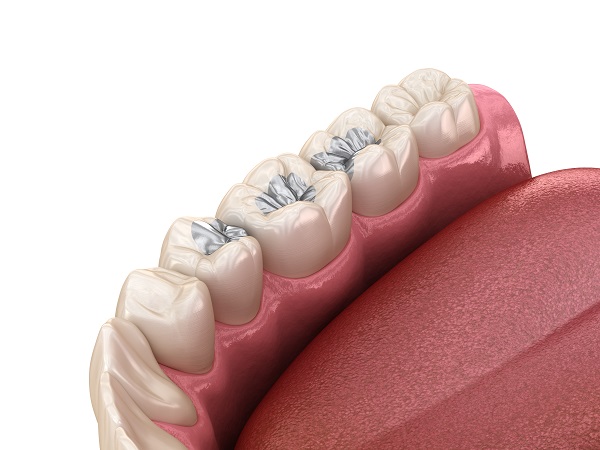 Answers to Questions about Dental Sealants