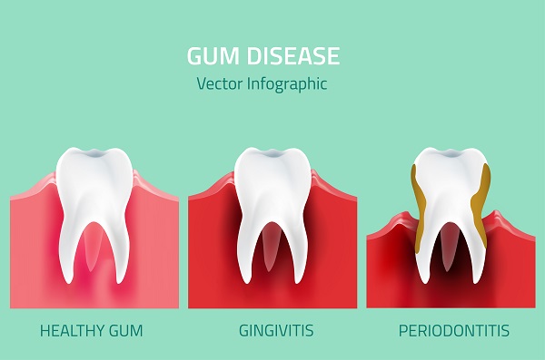 Are Gum Disease and Gingivitis the Same Thing?
