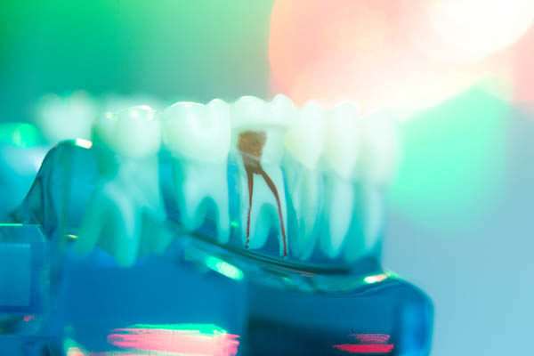 Root Canal Treatment Tucson, AZ