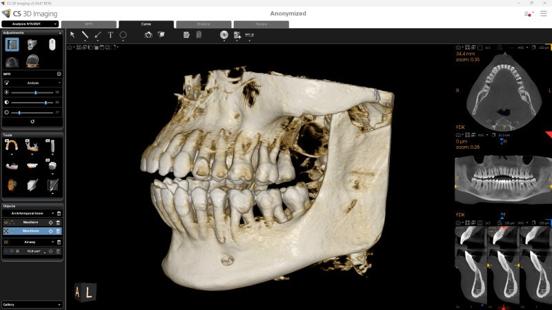 Carestream CS 3D Imaging software showing a three-dimensional CBCT reconstruction of a jaw and teeth