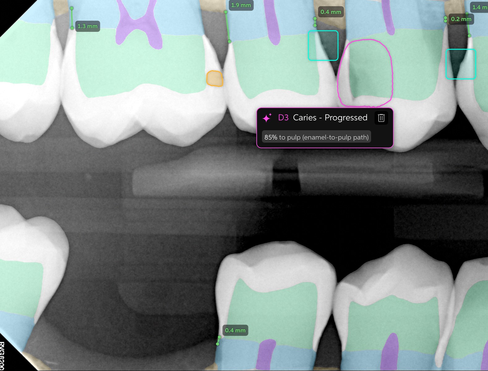The same X-ray with Pearl AI findings and measurements highlighted