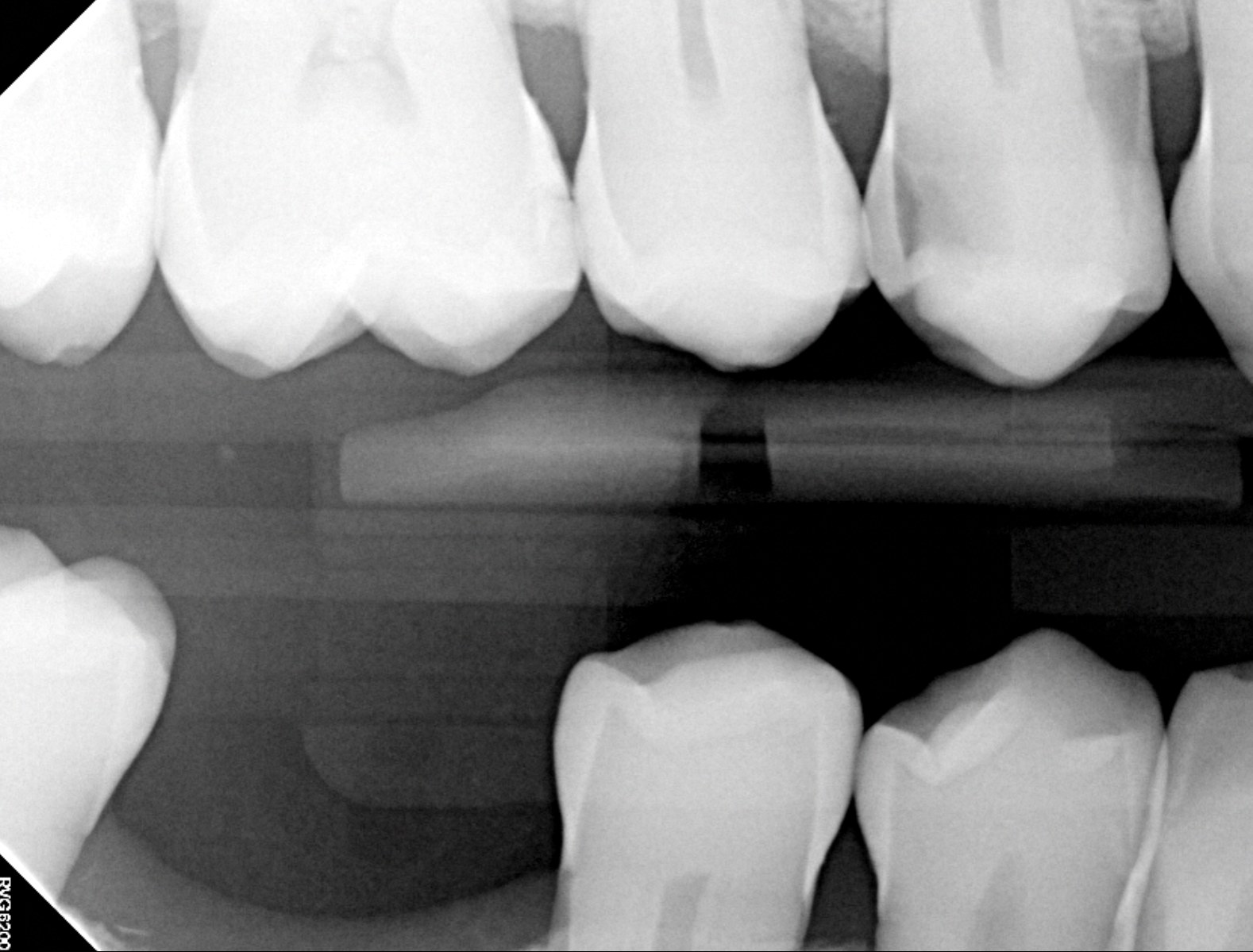 A bitewing X-ray from our office, as captured