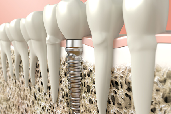 dental implants Tucson, AZ