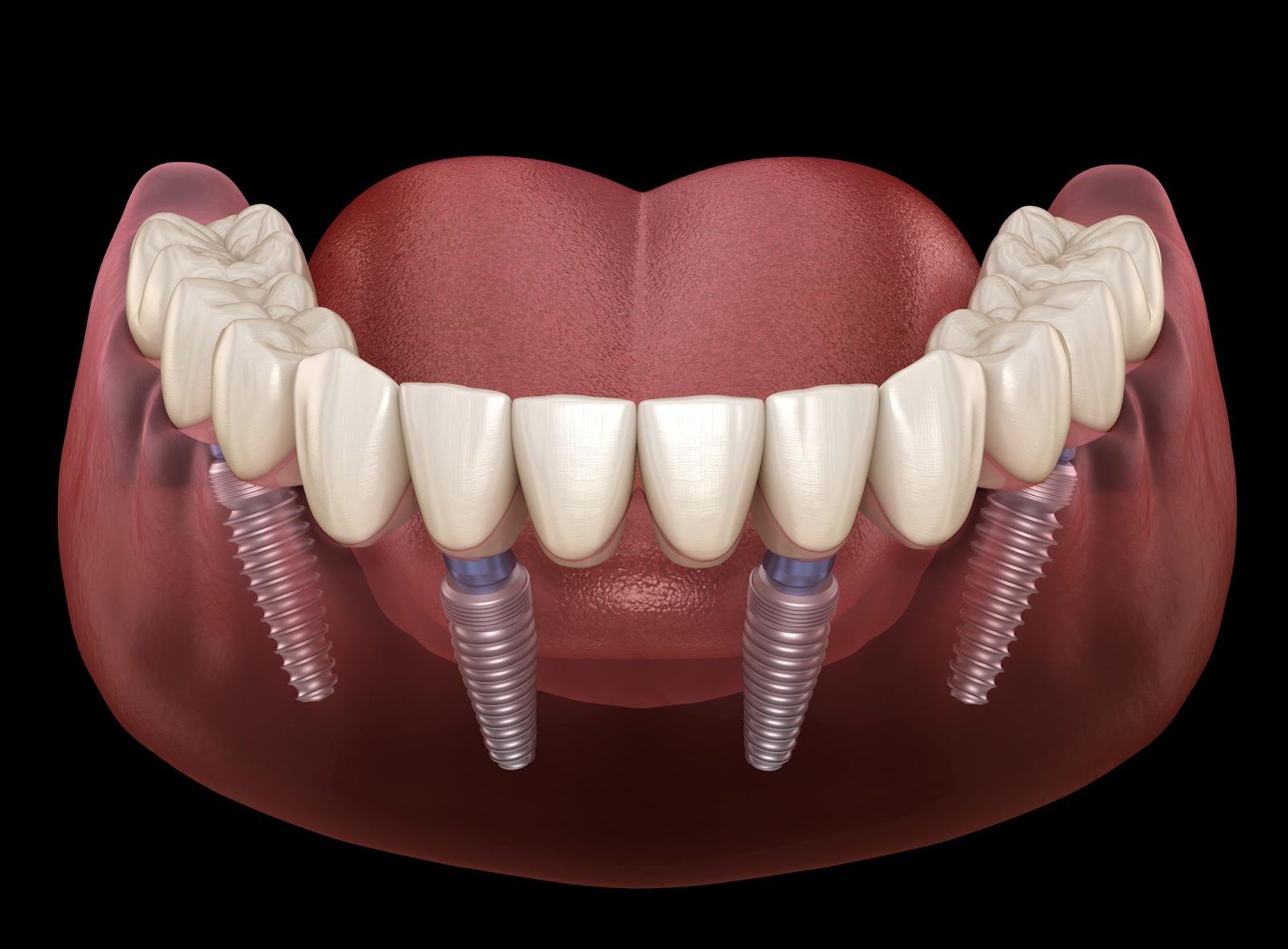 The History Of All On   Dental Implants