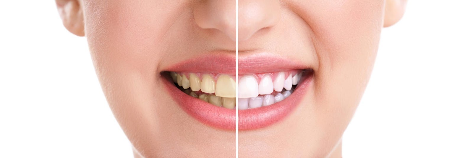 Teeth Whitening Options For Your Type Of Dental Stains
