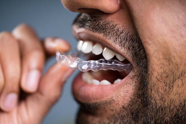 Why You Should Remove Clear Aligners While Eating
