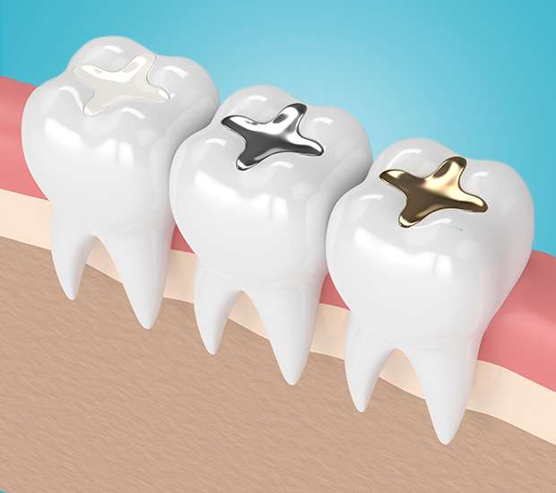 Tucson Composite Fillings