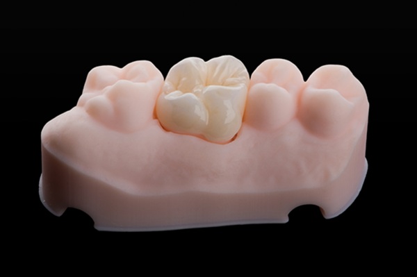 The FAQs Of Zirconia Crowns