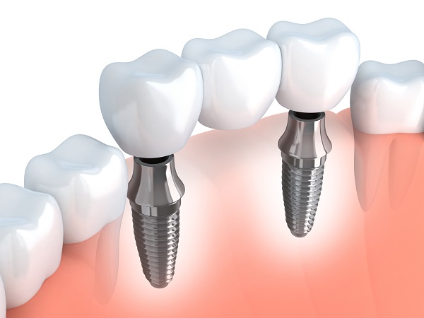 Dental Implants