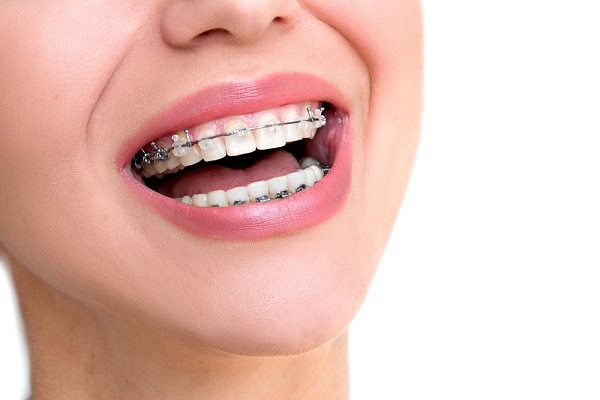 How Long Do Teeth Straightening Treatments Last?